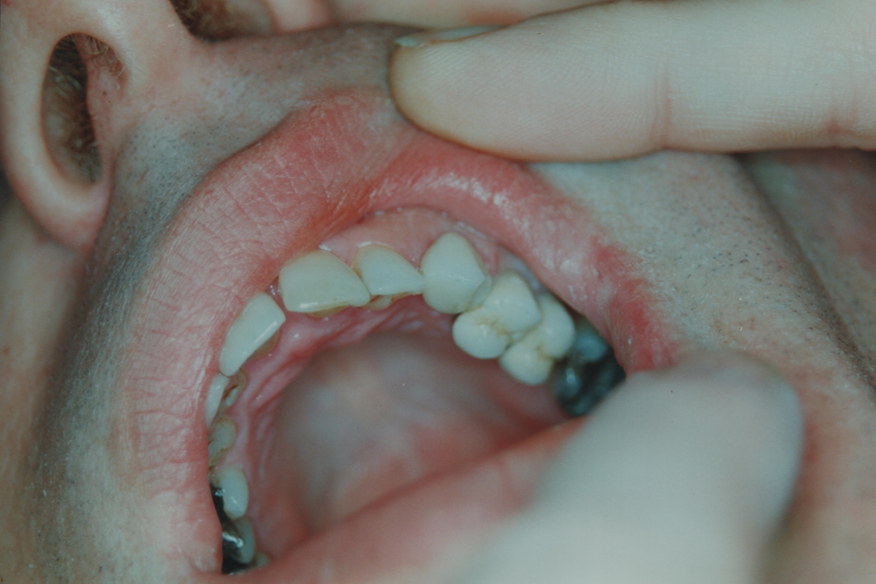 Tooth with crown