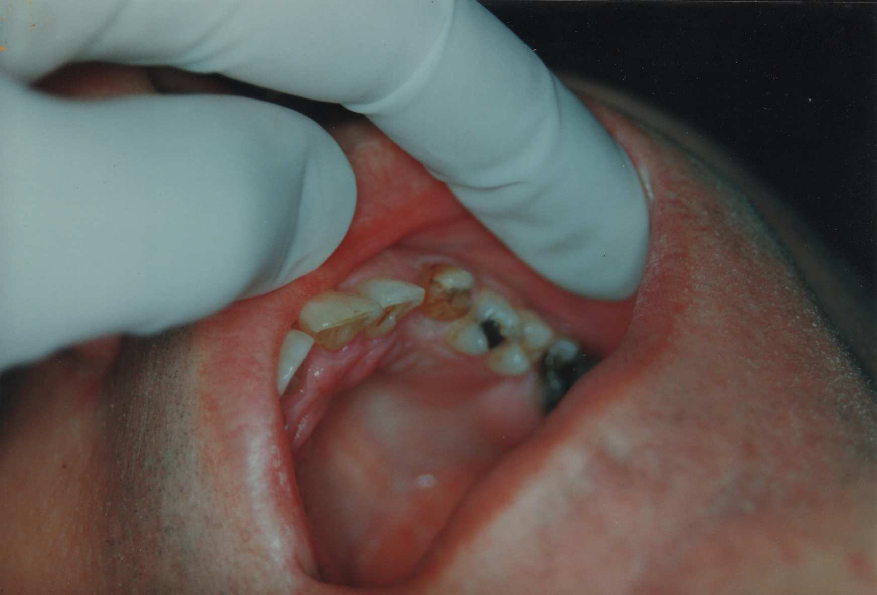 Broken down tooth before