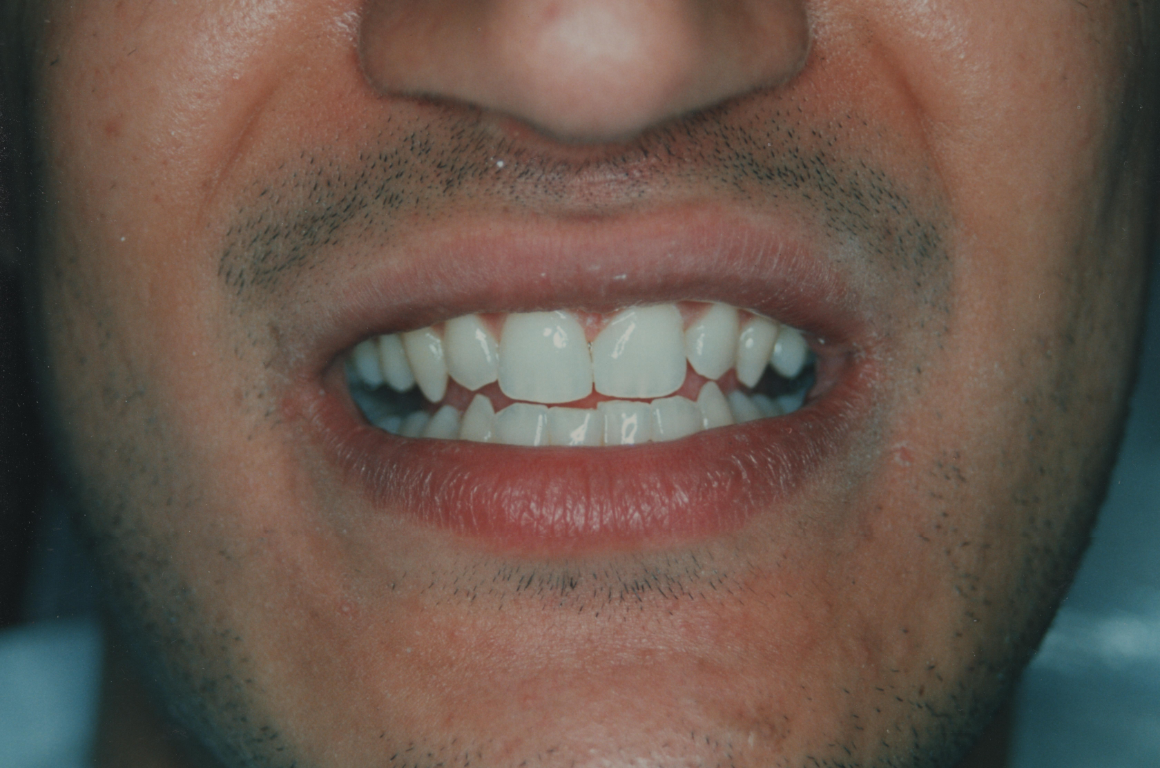Diastema after gap closure treatment