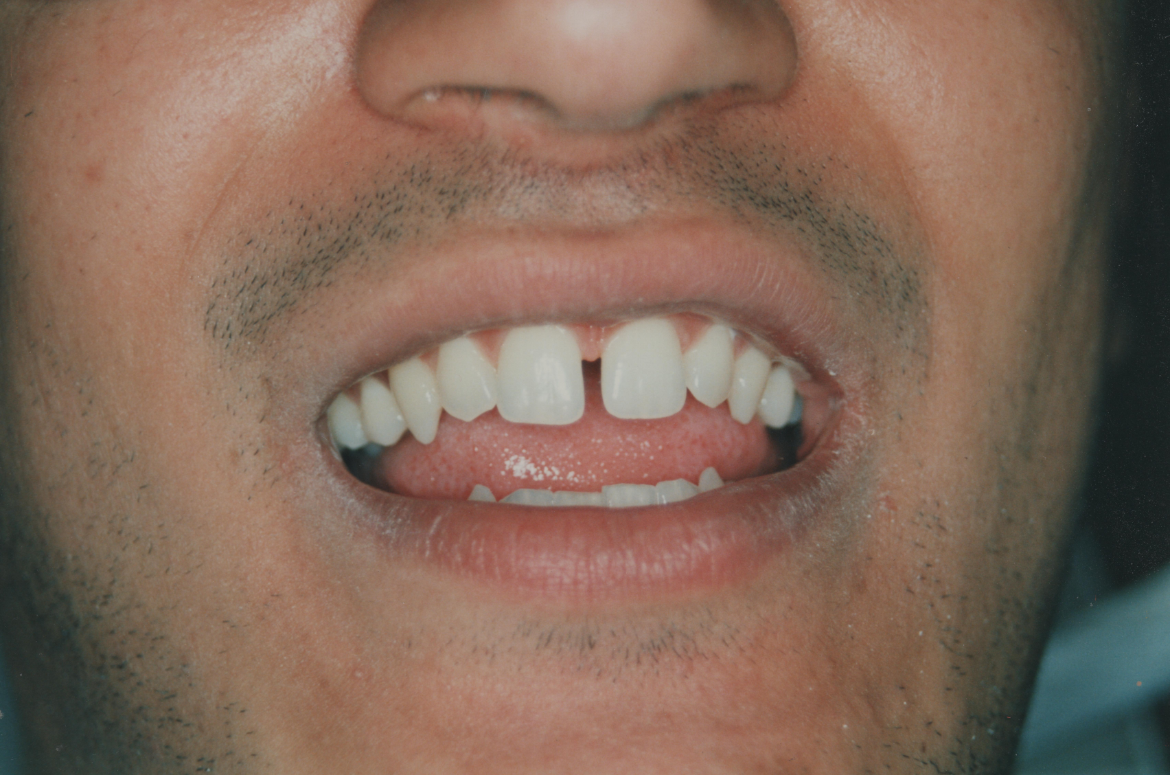 Diastema before gap closure treatment